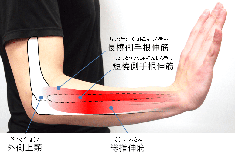 肘 と は テニス テニス肘（上腕骨外側上顆炎）とは？症状や原因についても解説